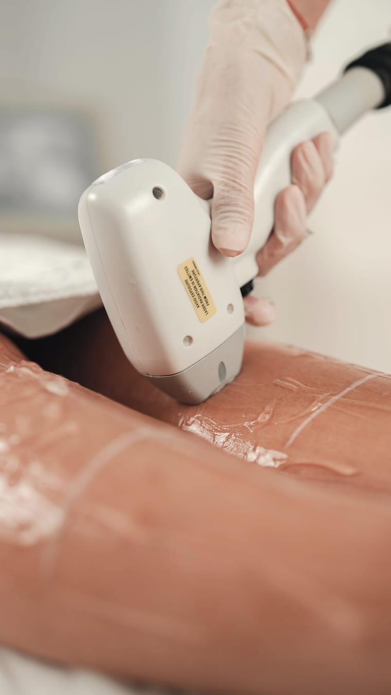 Cooling gel spread across a client's back before a laser hair removal pass