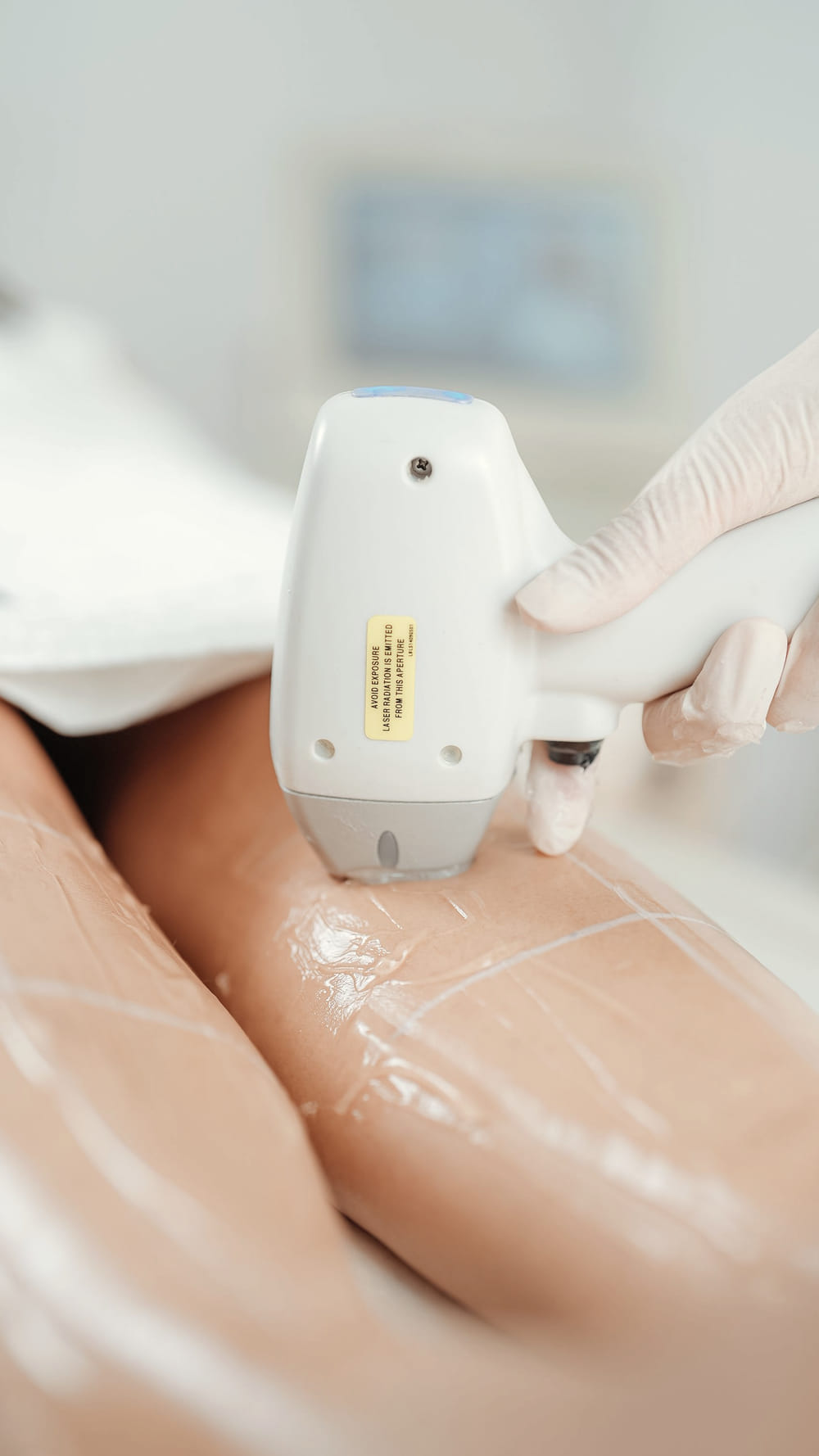 A clinician in scrubs guides a laser handpiece along a client's arm during a hair removal session, the client wearing protective eyewear